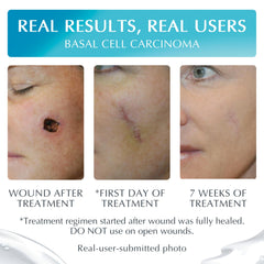 MyNewGel being applied to healed scar demonstrating gentle daily use benefit