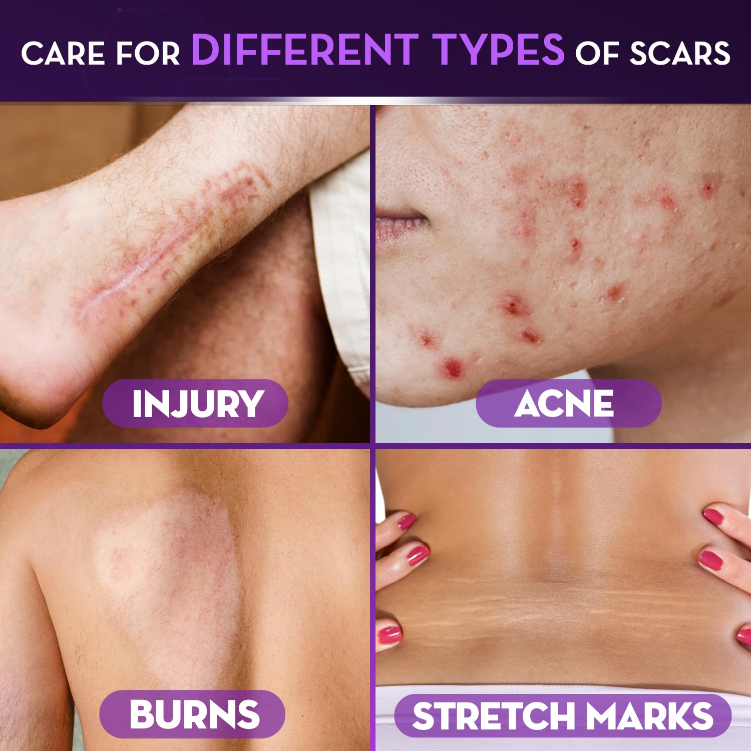 Cicatricure application on hand demonstrating easy spread and comfort