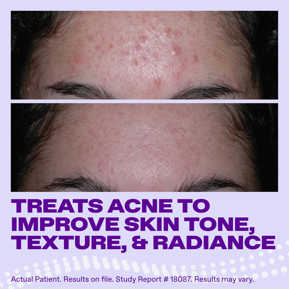 Differin Epiduo shown alongside moisturizer and SPF30 sunscreen to show recommended pairing
