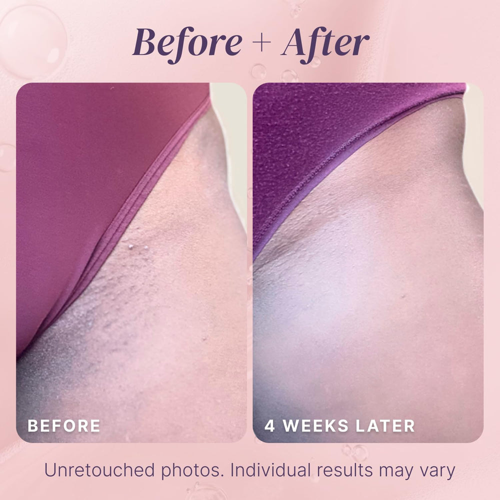 Divine Derriere before and after comparison showing reduced ingrown hairs