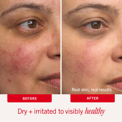 First Aid Beauty cream applied to face delivering gentle hydration