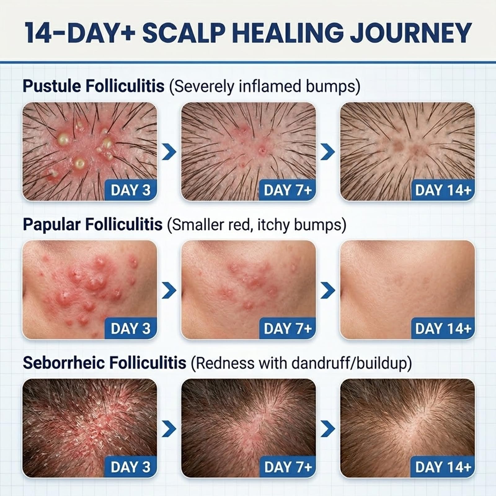 FLYLEAF on healed skin patch showing smoother, less irritated skin benefit