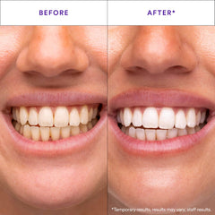 HISMILE close-up of purple strip texture highlighting secure adhesive