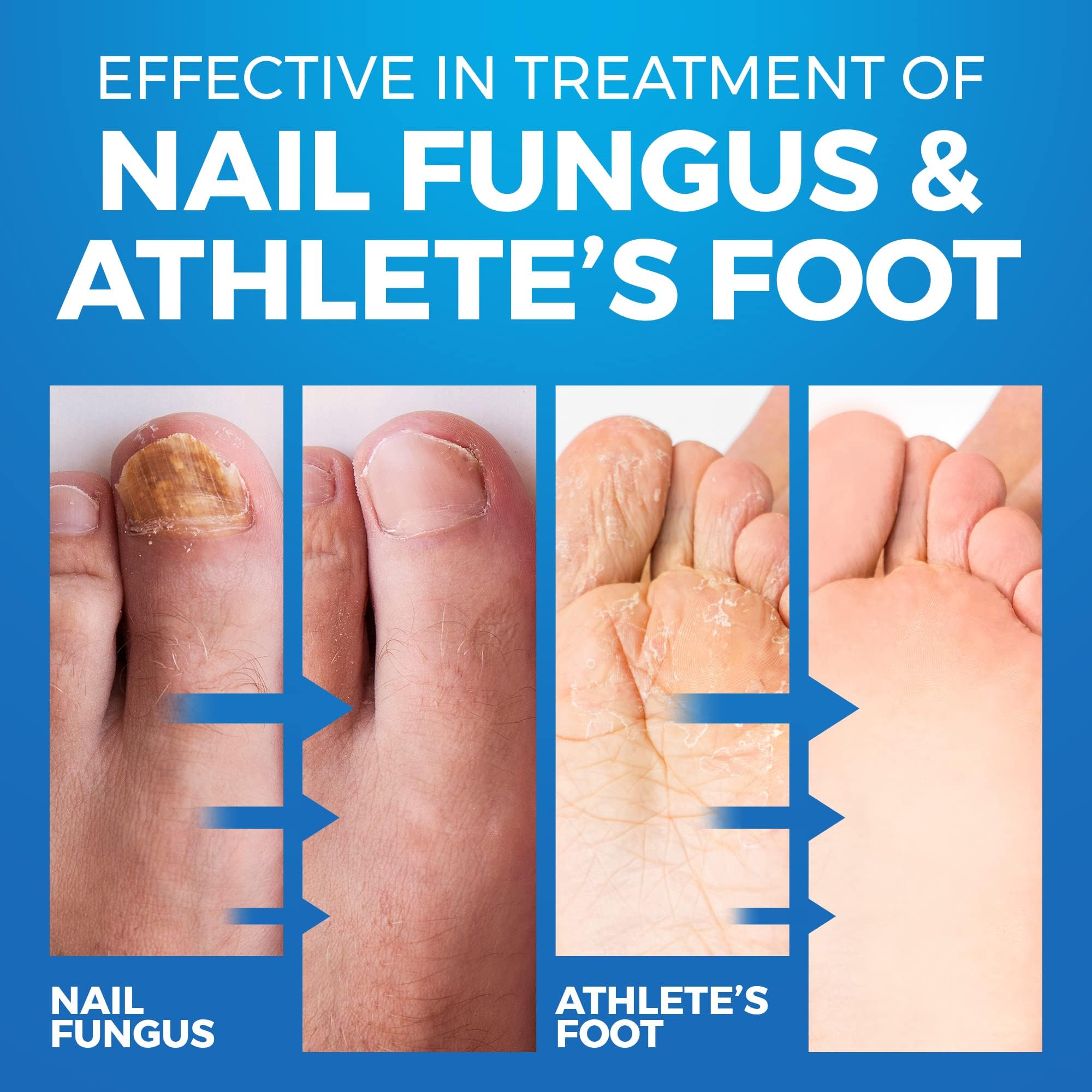 Imperial Feet being sprayed inside a shoe to prevent fungal reinfection