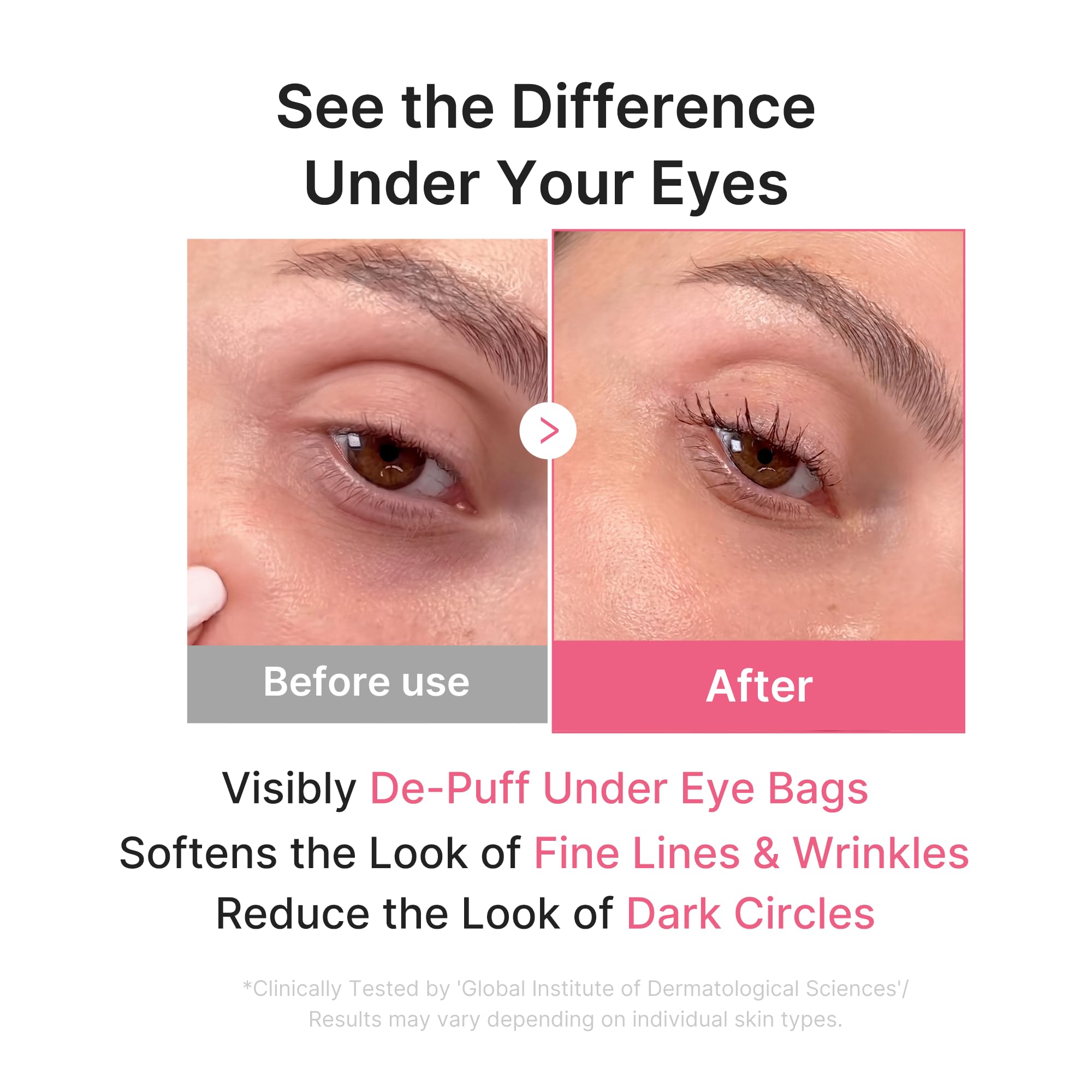 medicube patch applied under eye demonstrating de-puffing effect