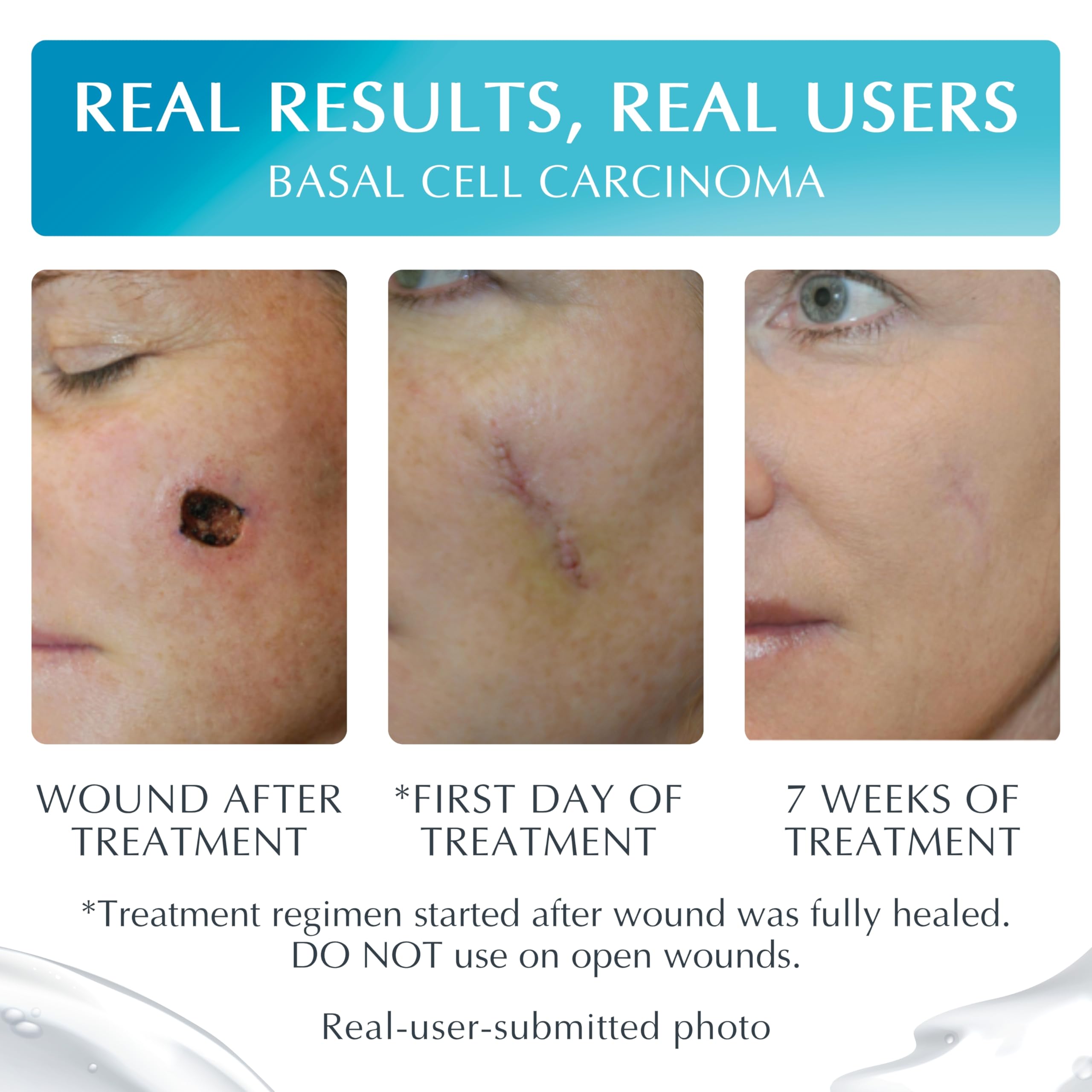 MyNewGel being applied to healed scar demonstrating gentle daily use benefit