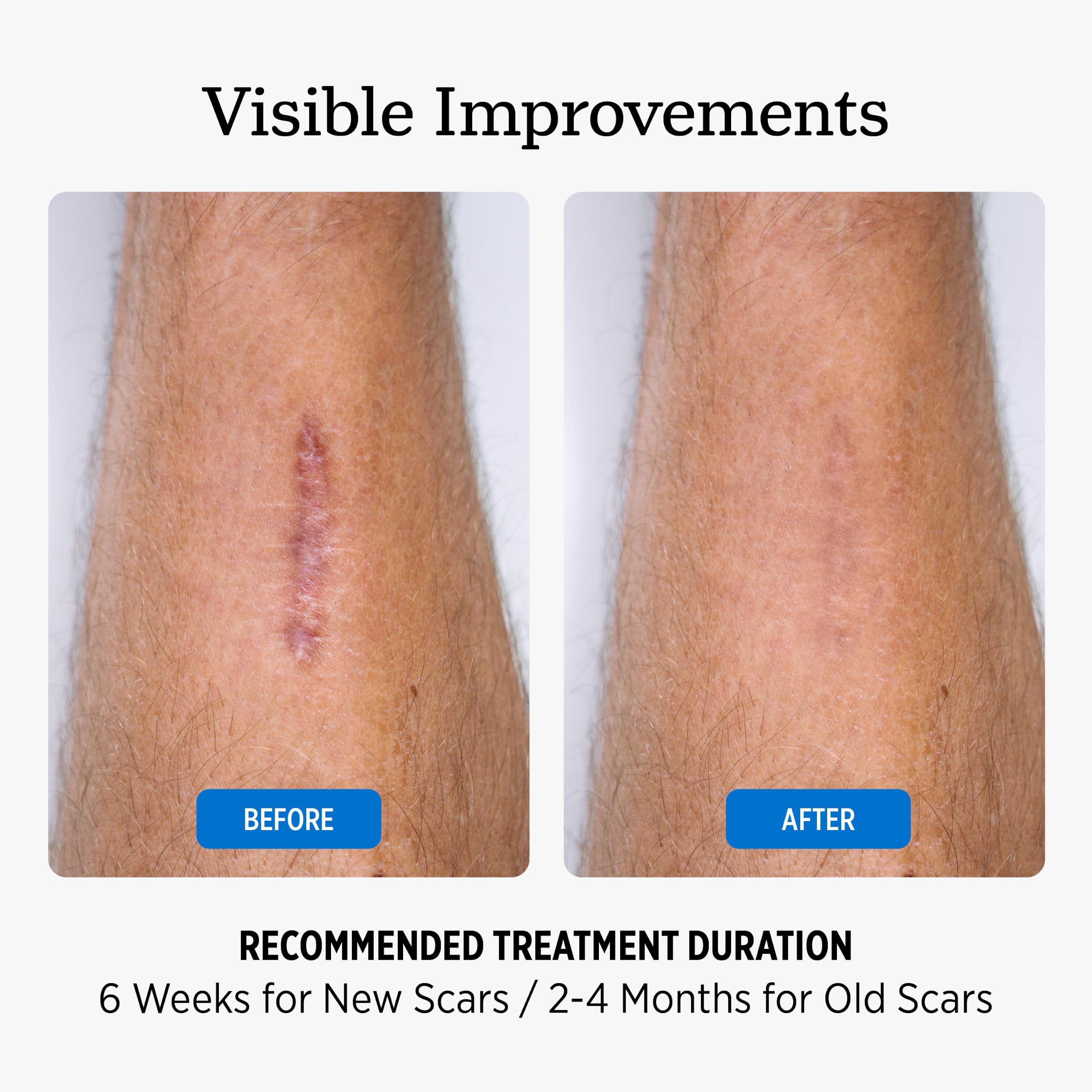 NUVADERMIS forehead wrinkle patch use showing subtle overnight smoothing
