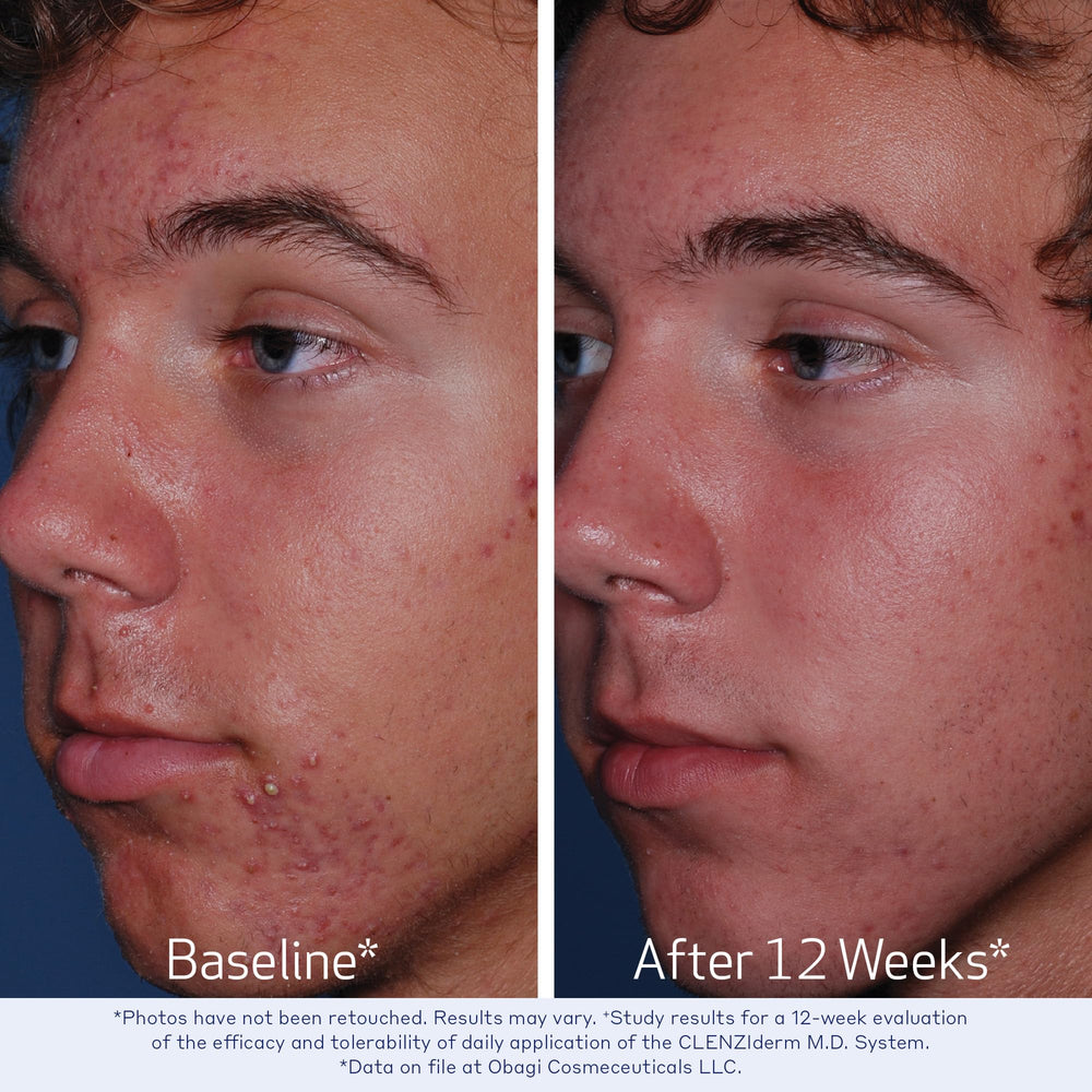 Obagi Medical close-up of salicylic acid info highlighting exfoliation benefit