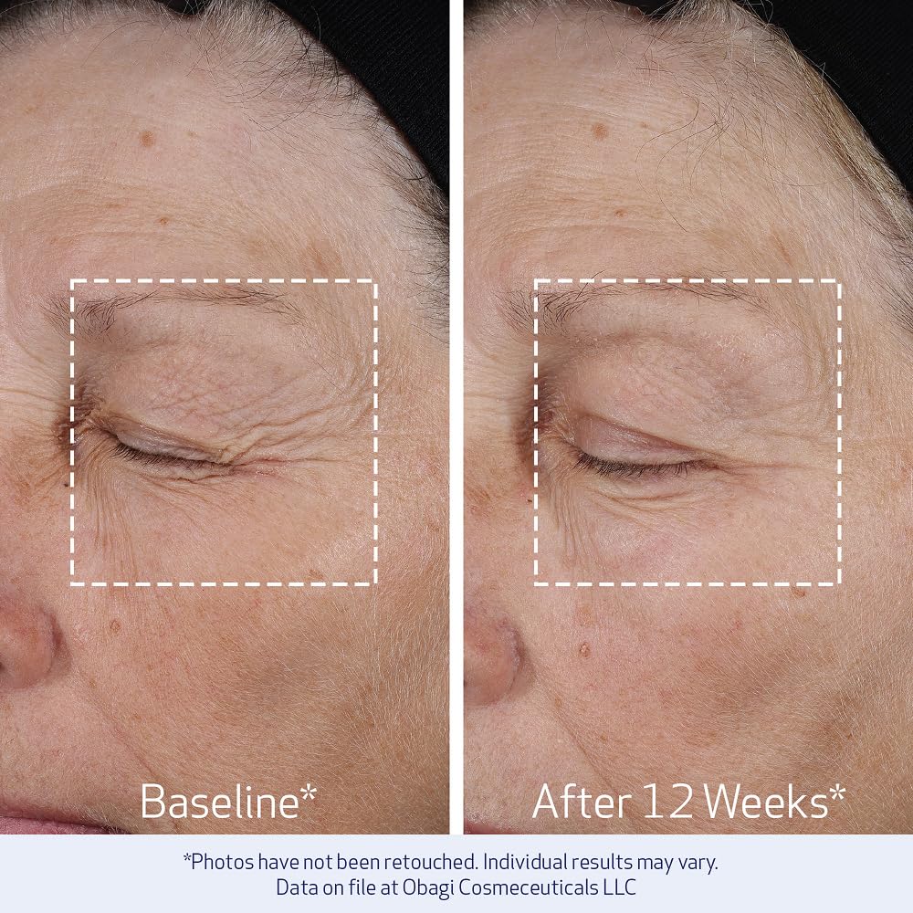 Applying Obagi ELASTIderm to cheek demonstrating lifting massage and improved facial contour