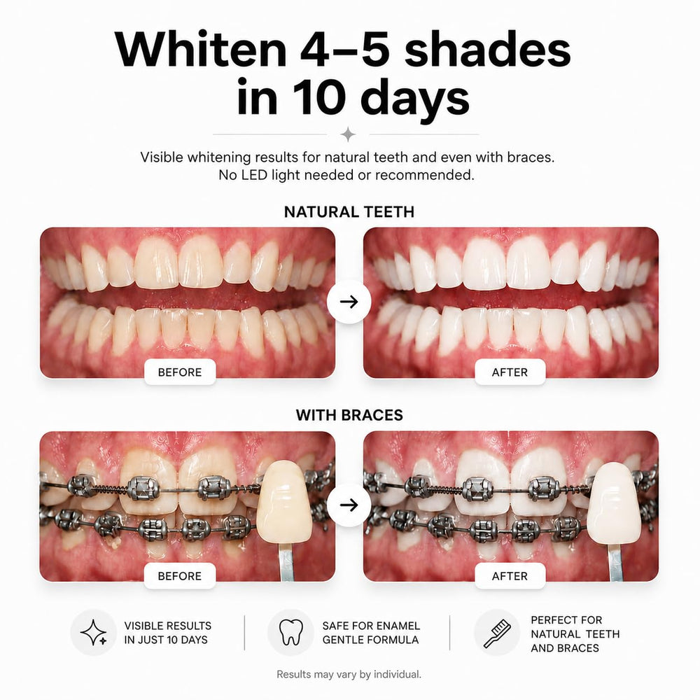 Opalescence contents laid out showing ten complete upper and lower treatments