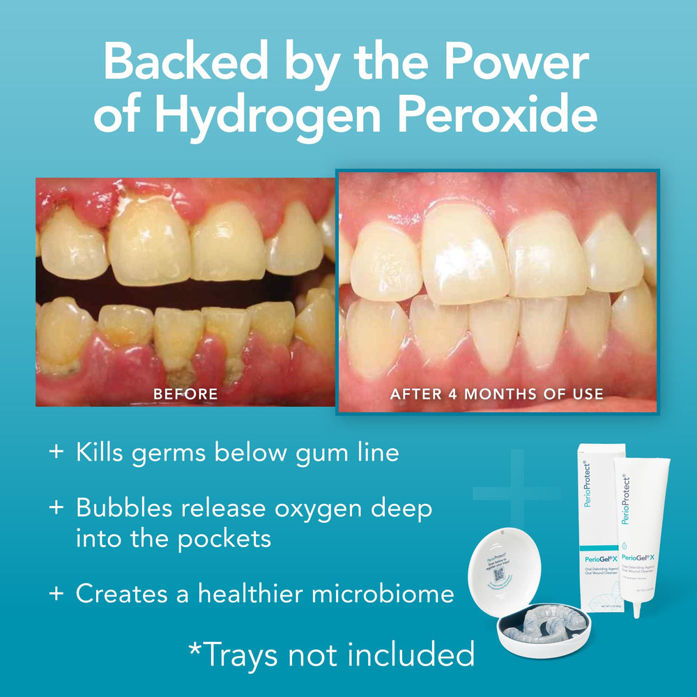 Perio Protect periogelx before and after smile comparison illustrating gentler whitening effect