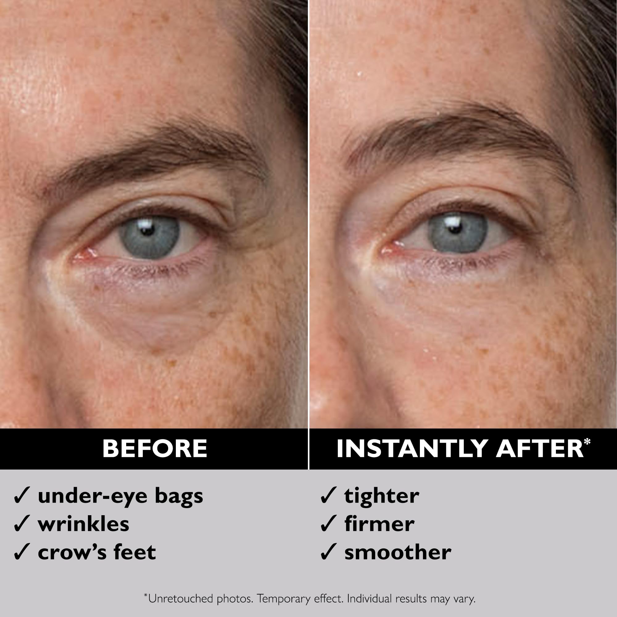 Peter Thomas Roth before and after under-eye showing reduced puffiness