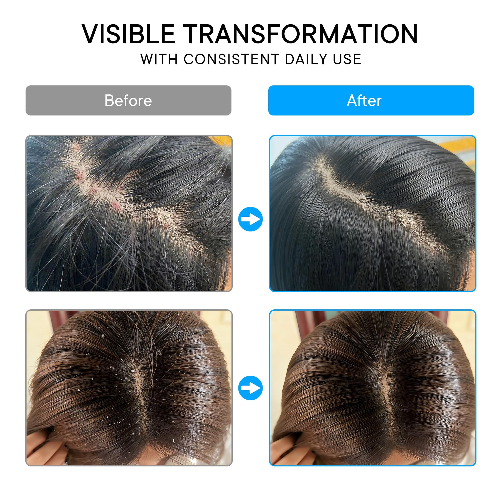 ProBliva before and after scalp images showing reduced visible flaking benefit