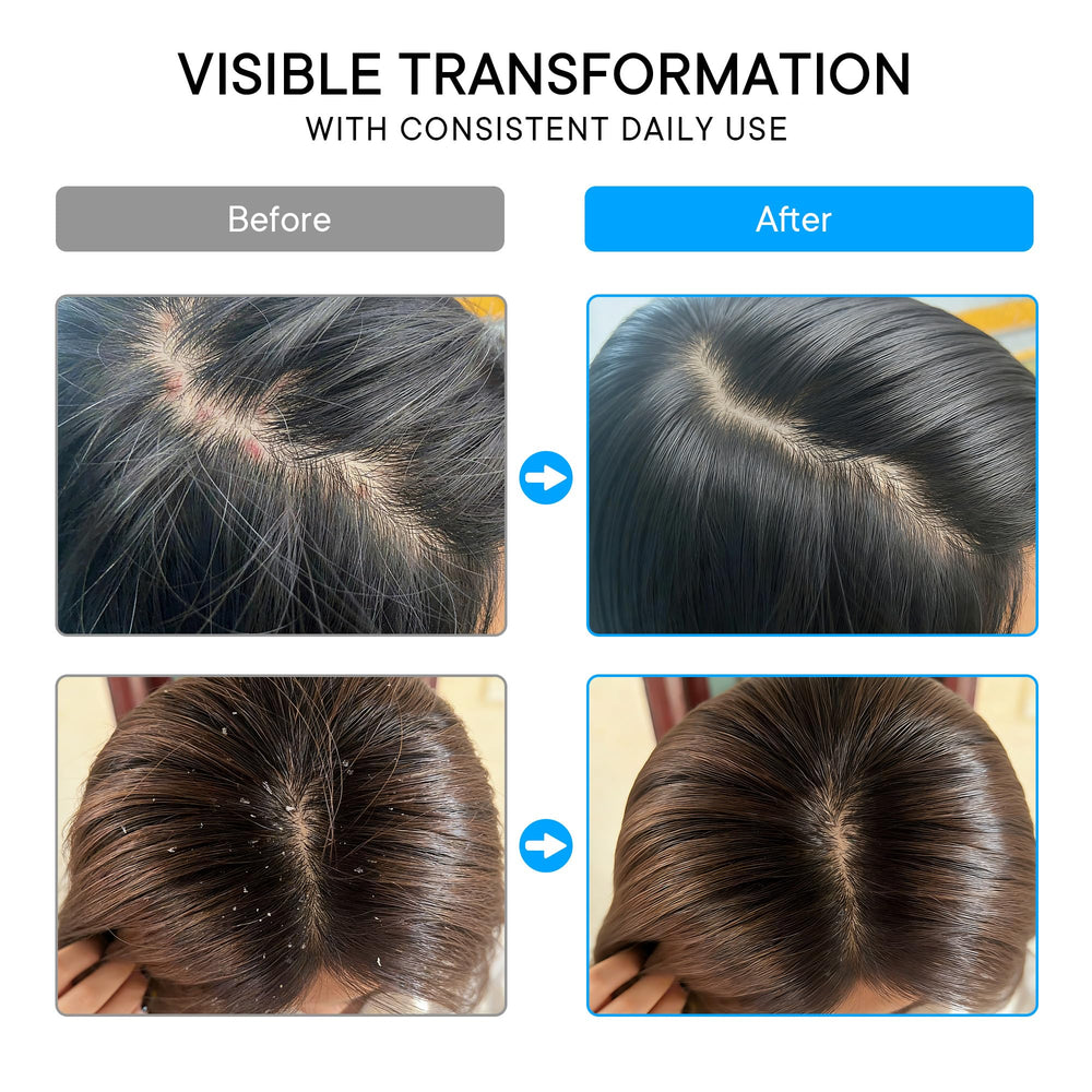 ProBliva before and after scalp images showing reduced visible flaking benefit