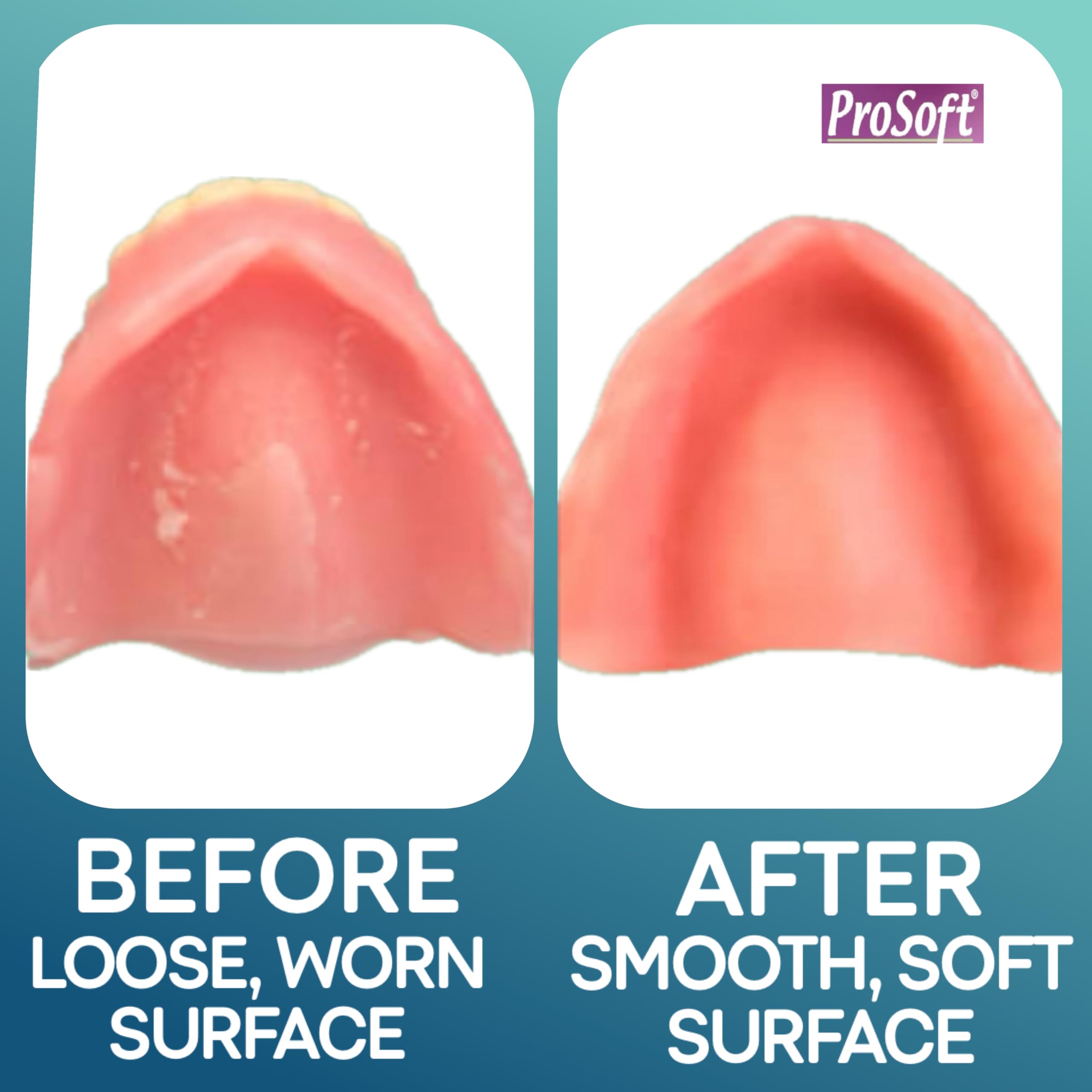 ProSoft Professional Denture Reliner next to ruler showing kit size and sufficient quantity advantage