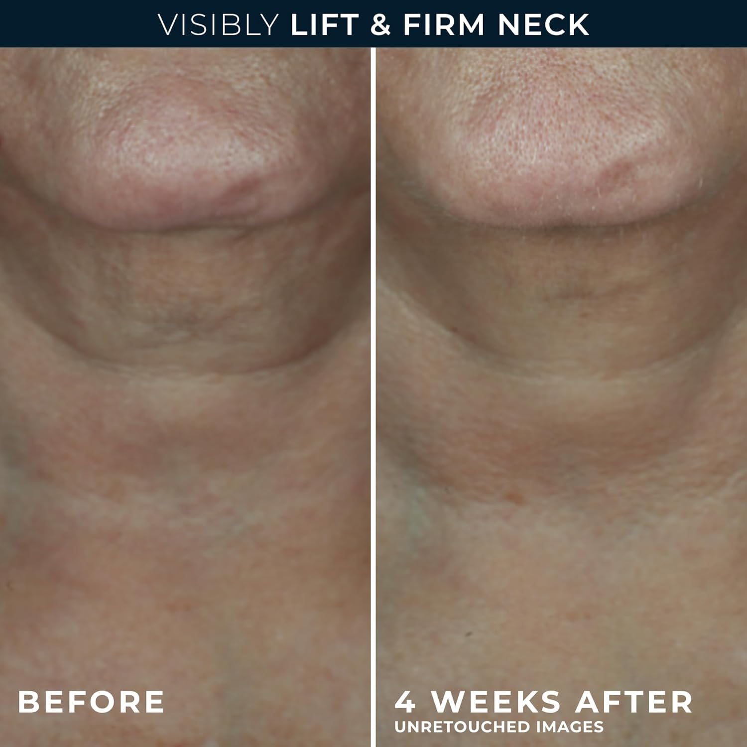 RoC application on neck and jawline demonstrating upward strokes for lift and contouring benefit