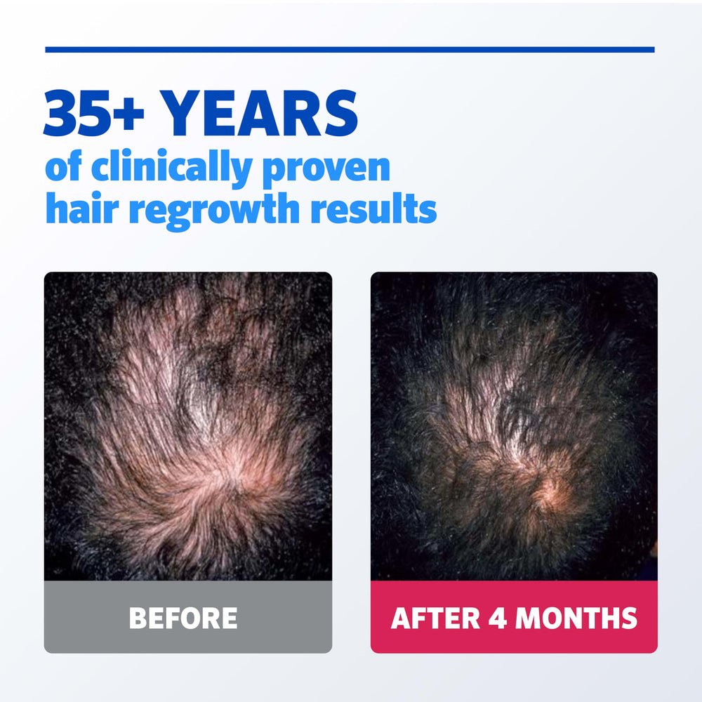 Man applying Rogaine to scalp showing correct twice-daily use and ease of integration