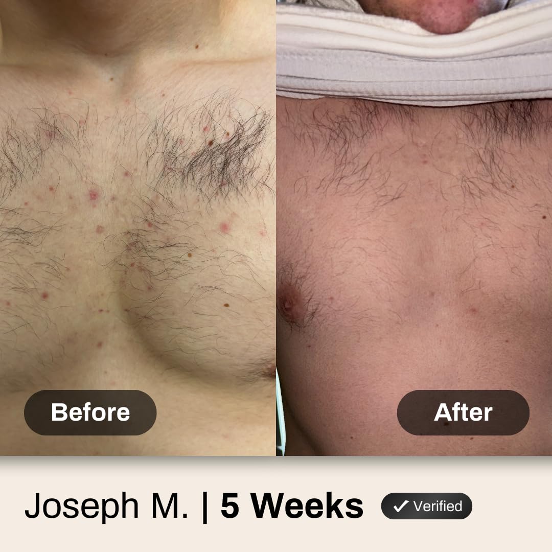 Shield applied to back and shoulder area showing targeted acne treatment in use