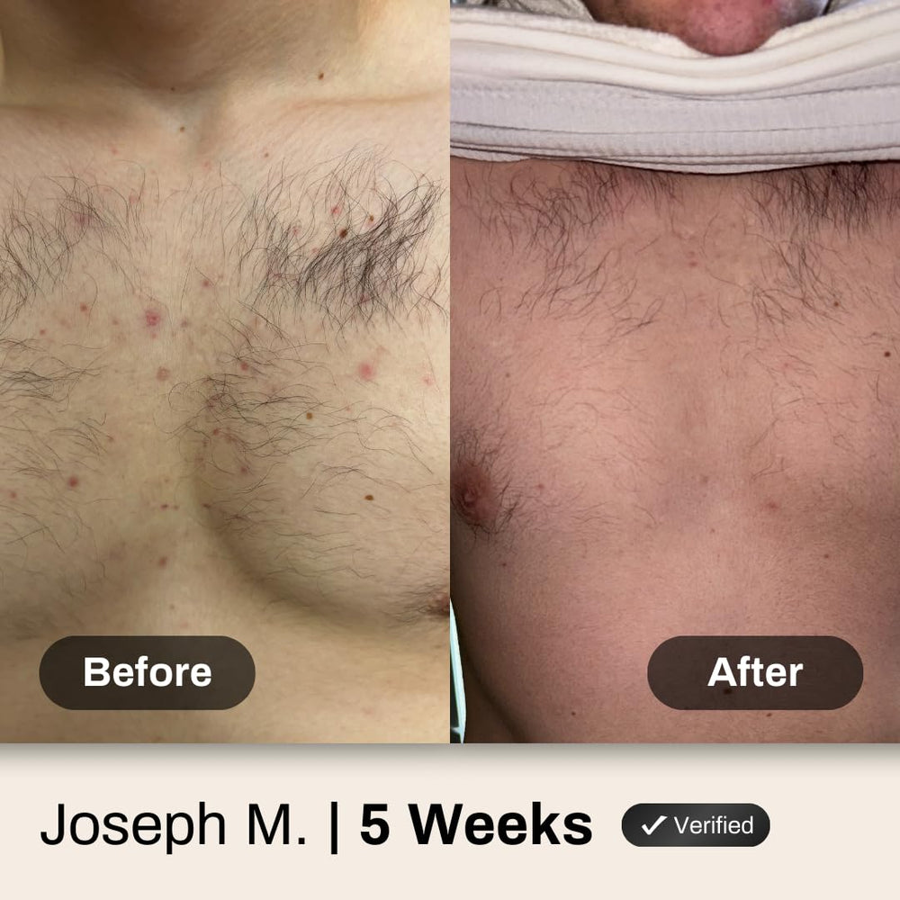 Shield applied to back and shoulder area showing targeted acne treatment in use