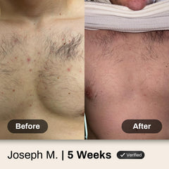 Shield applied to back and shoulder area showing targeted acne treatment in use
