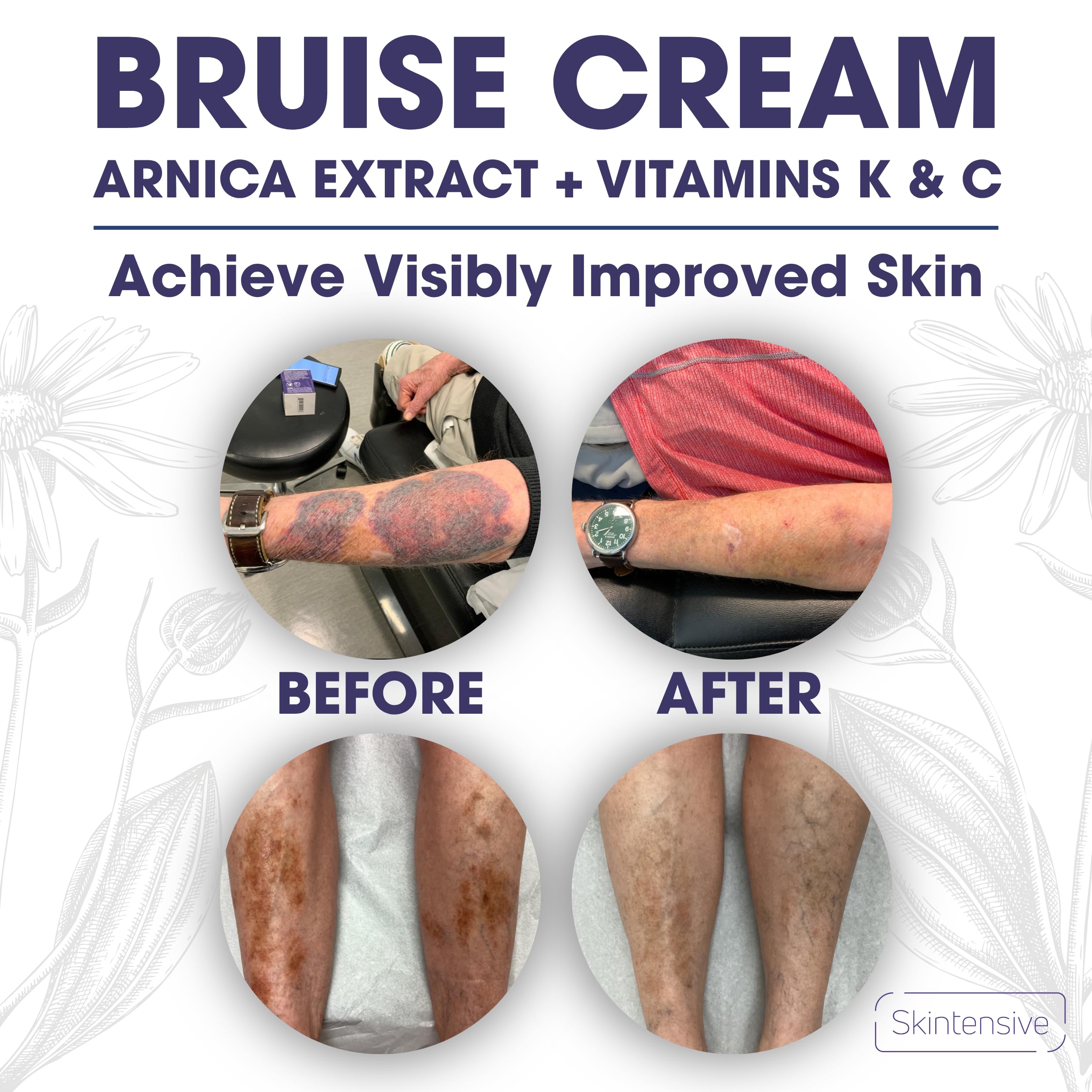 SKINTENSIVE forearm comparison illustrating reduced-looking discoloration after use