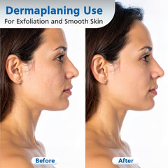 Swann-Morton #10R blade mounted in a dermaplane handle for controlled treatments
