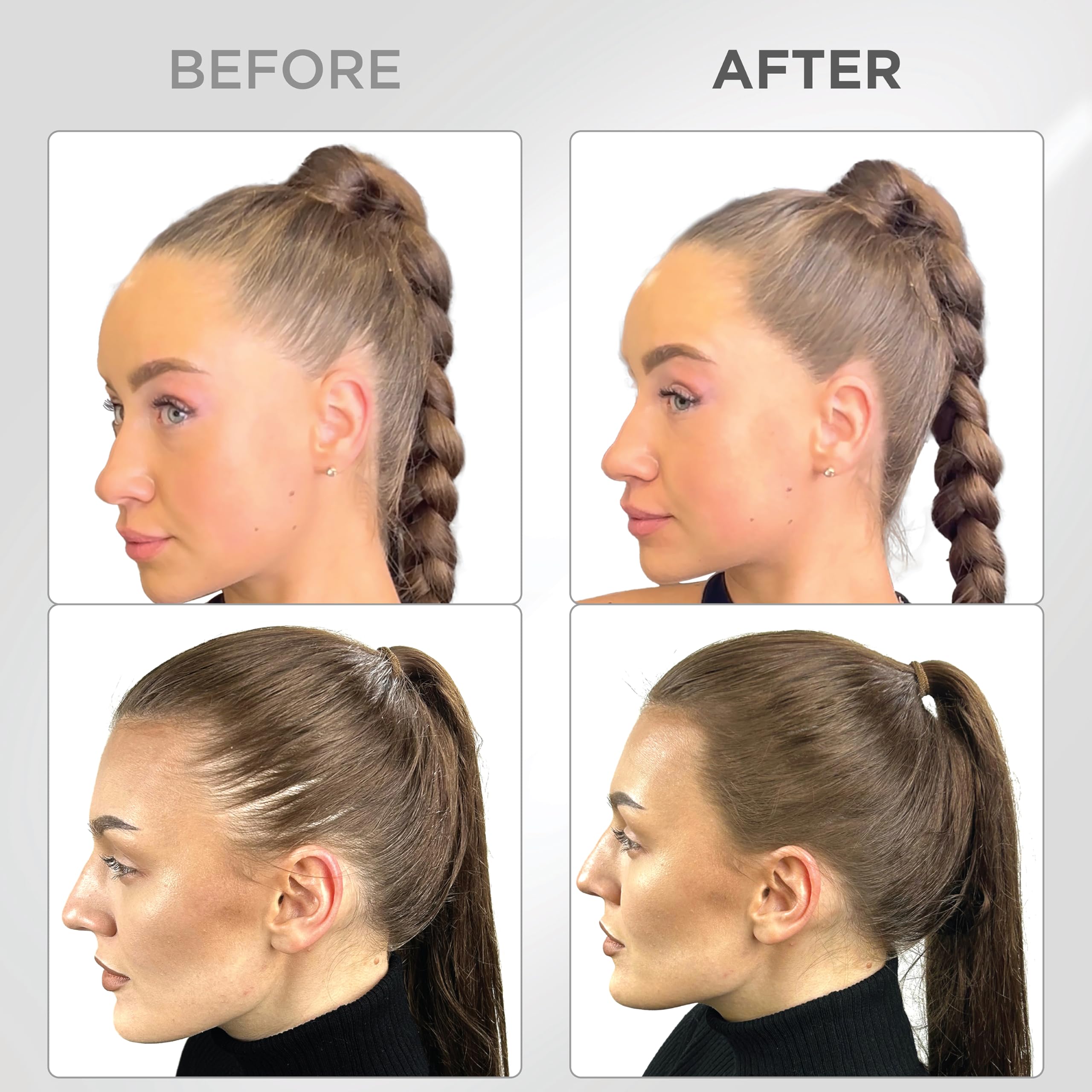 Thick Fiber applied at hairline demonstrating quick concealment benefit