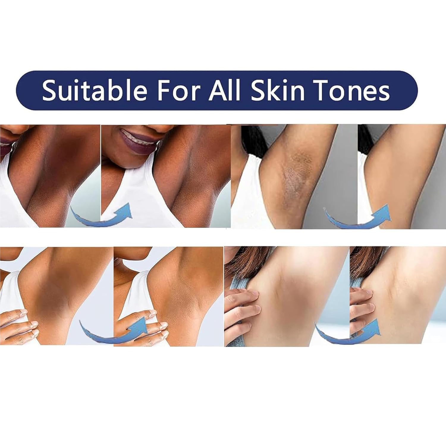 Vcetree cream applied to bikini line demonstrating careful, private-area use and even tone